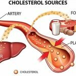 Cholesterol là gì và bệnh cholesterol cao