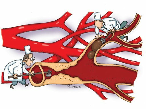 benh tai bien mach mau nao, bệnh tai biến mạch máu não