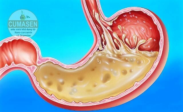 trào ngược dạ dày thực quản có nguy hiểm không