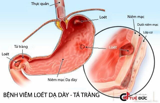 Kết quả hình ảnh cho đau dạ dày