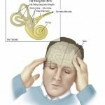Bệnh rối loạn tiền đình có nguy hiểm không?