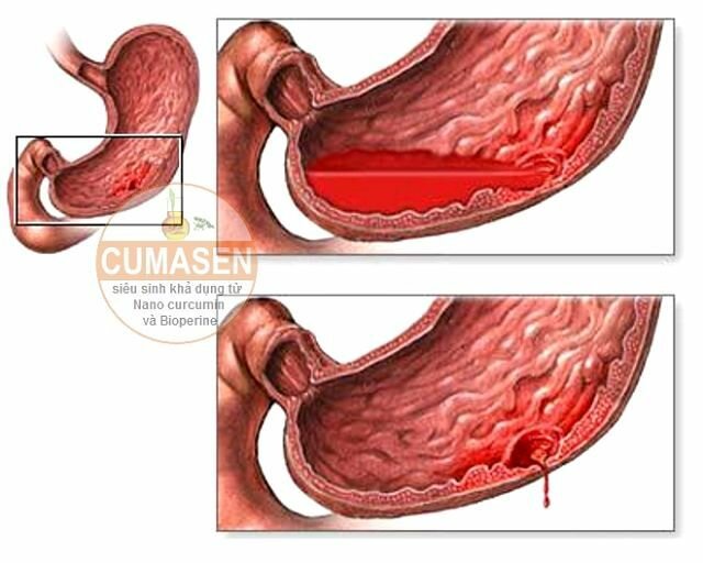 xuất huyết dạ dày