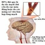 Tai biến mạch máu não là gì?