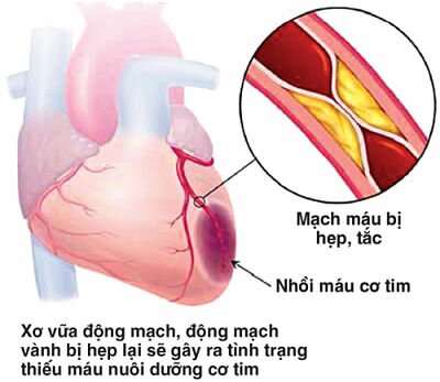 nguyen nhan xo vua dong mach, điều trị xơ vũa động mạch, cách chữa xơ vữa động mạch, thuoc chong xo vua dong mach