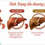 Người bị gan nhiễm mỡ sẽ có dấu hiệu gì?
