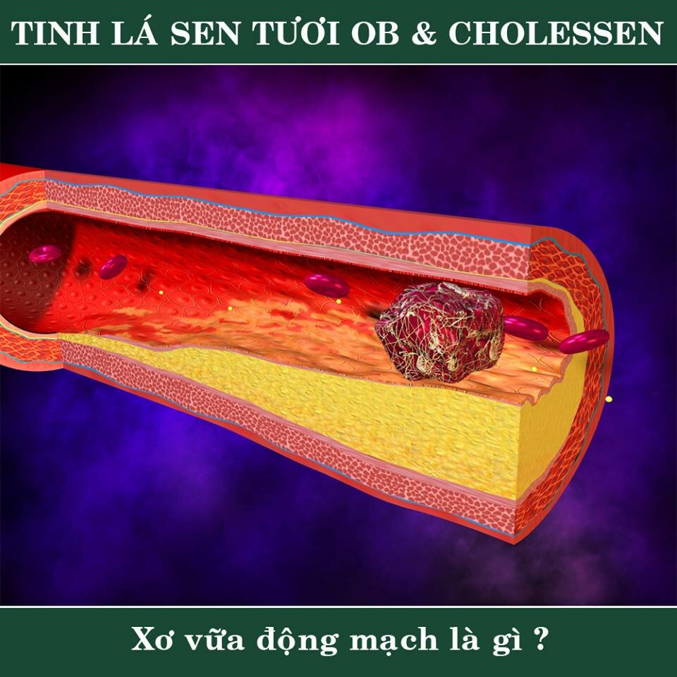 xơ vữa động mạch là gì