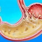 Bệnh trào ngược dạ dày thực quản và triệu chứng