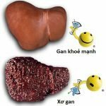 Điều trị bệnh gan nhiễm mỡ thế nào cho hợp lý?